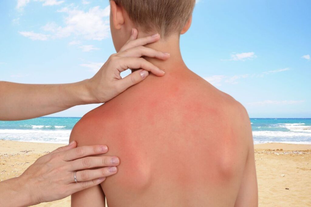 alergija na sunce kod djece 